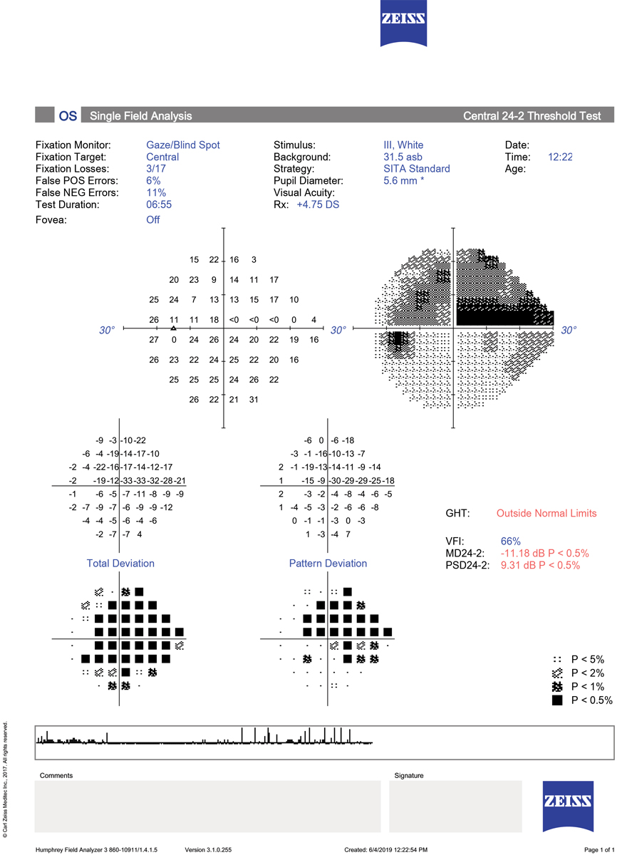 What Is Central Visual Field